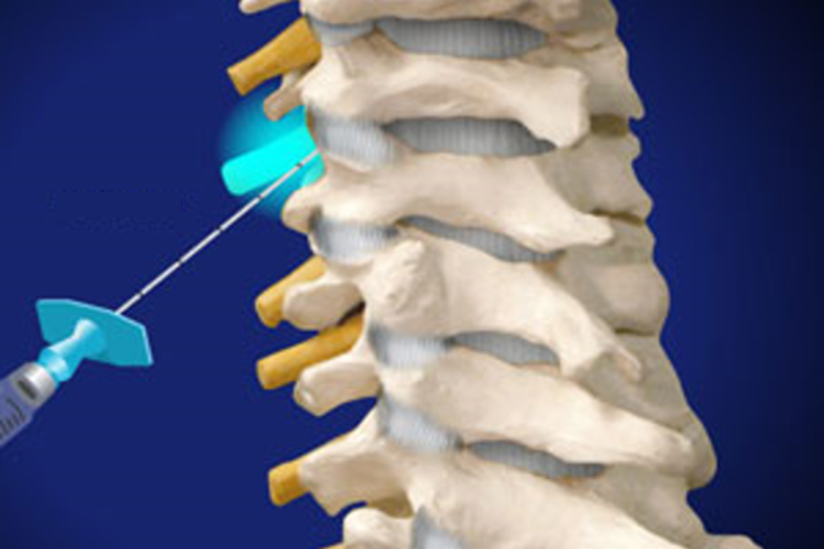 Nerve Block Injections