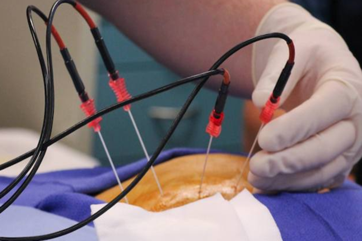 Radio Frequency Ablation