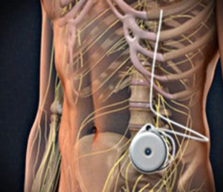 Morphine Pump Implantation