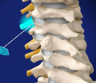 Nerve Block Injections